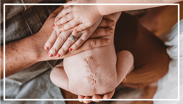 Espina Bífida | Asesbih Perú